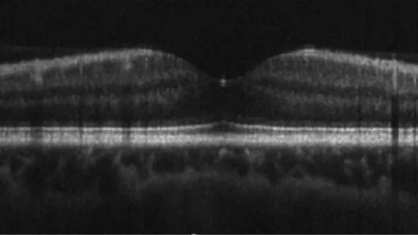 SD-oct-b-scan Raman spectrscopy applications